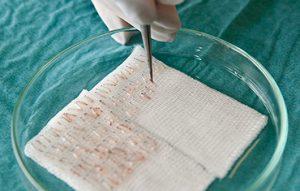 Przeszczep włosów w Turcji