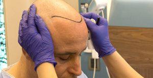 Przeszczep włosów Wrocław gdzie najlepiej