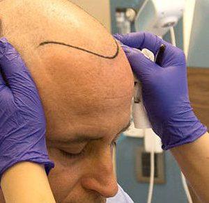 Przeszczep włosów Wrocław gdzie najlepiej