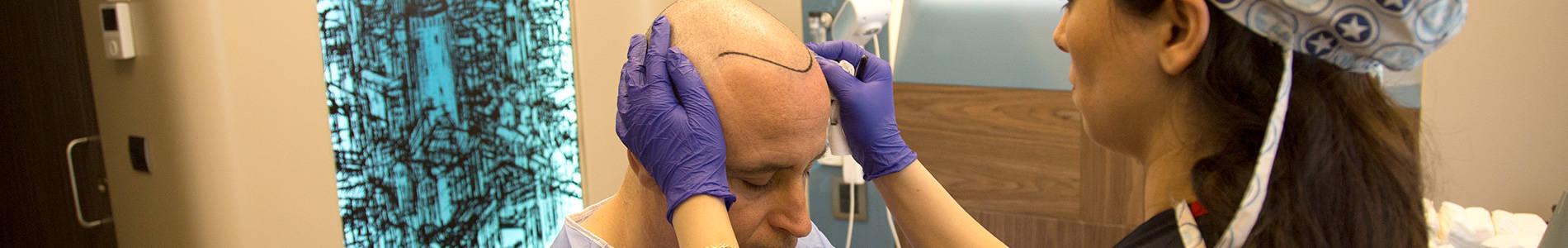 Przeszczep włosów w Stambule