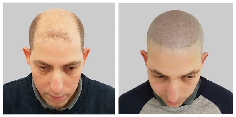 pigmentacja skóry głowy jako ratunek dla łysienia