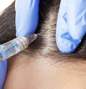 mezoterapia igłowa skóry głowy wrocław