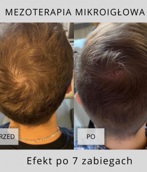Mezoterapia mikroigłowa